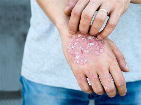 What Does A Rash On Your Hands Mean