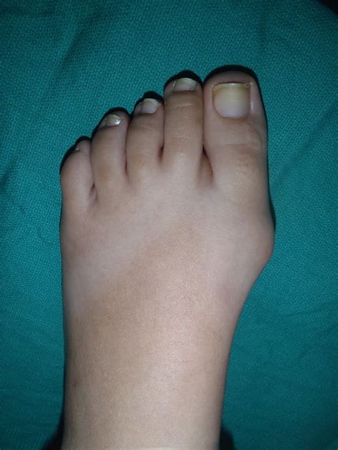 Small Bunion Flickr Photo Sharing