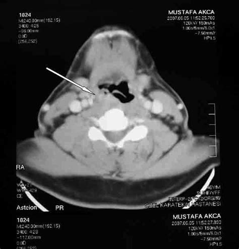 Computerized Tomography Ct Scans Of The Neck Showed A Mass In The