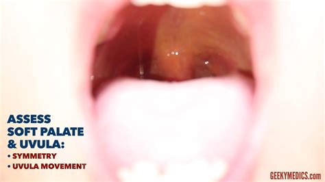 Normal Uvula In Cleft Palate