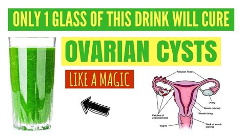 How To Get Rid Of Ovarian Cysts Naturally And Fast Without Surgery