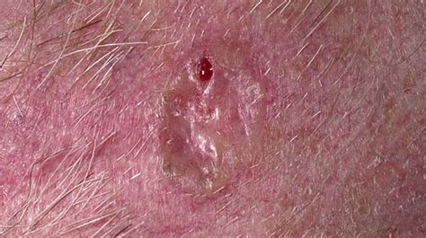 Basal Cell Carcinoma Bcc The London Dermatologist
