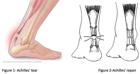 Achilles Tendonitis And Rupture Causes And Prevention Beltsville Foot