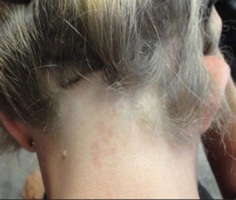 Alopecia totalis, alopecia universalis, patchy alopecia areata, ophiasis, diffuse alopecia areata, alopecia areata of the nails, nonscarring alopecia. Hair Loss at the Nape of the Neck: What are the main ...