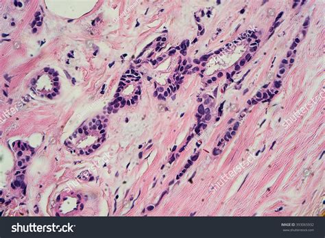 Breast Cancer Histology Microscopic Image Well Foto De Stock Editar