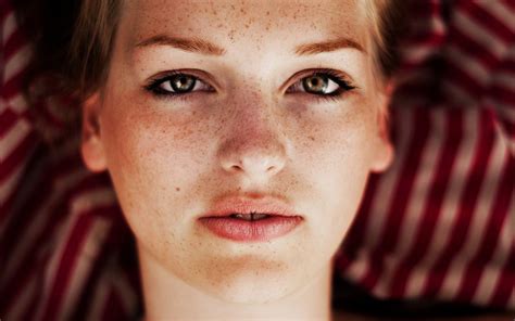 Freckles Eczema Treatment Brown Hair Dye Laser Eye Freckle Face