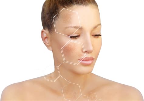 Age Spots Removal Colazadvanced Electrolysis For Age Spot Removal