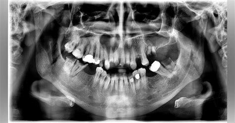 Diagnosis And Treatment For Breakthrough Clinical Oral Pathology Case