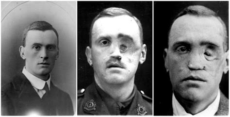 Faces From The Front Incredible Before And After Photos Show World War