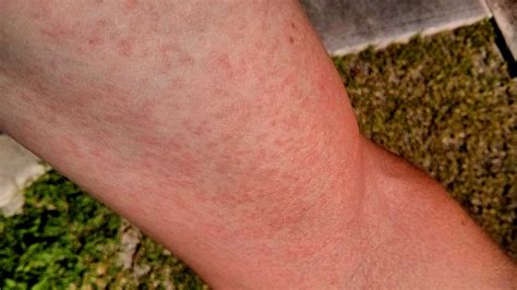 Viral Fever Rash In Adults Gue Viral