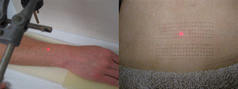 The Effect Of Repeated Laser Stimuli To Ink Marked Skin On Skin