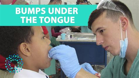 Bumps Under The Tongue Symptoms And Causes Youtube
