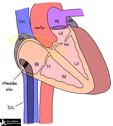 Intracardiac Echocardiography Ice Rkmd
