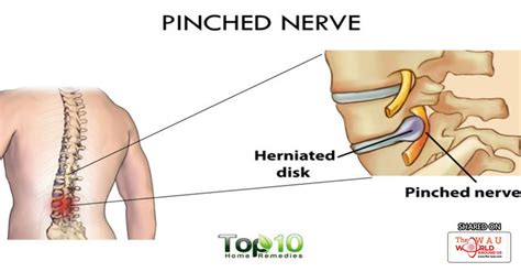 Home Remedies For A Pinched Nerve Blog Health Wau