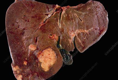 Undifferentiated embryonal sarcoma of the liver (uesl) is a rare kind of liver cancer that happens mostly in children. Secondary liver cancer - Stock Image - C012/5422 - Science ...