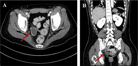 Abdomino Pelvic Ct Scan A Axial View And B Coronal View Showing A