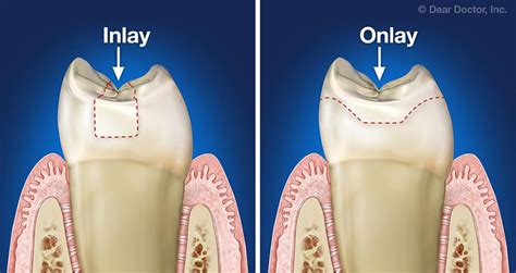 Inlays And Onlays Northwest Dental Glyndon Maryland