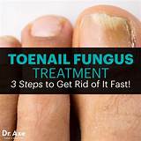 Photos of Holistic Cure For Nail Fungus