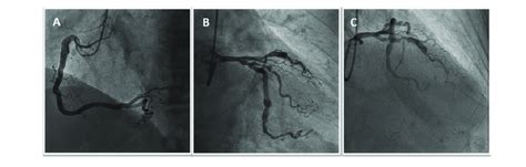 Urgent Coronary Angiography Shows Atherosclerosis Of The Right Coronary