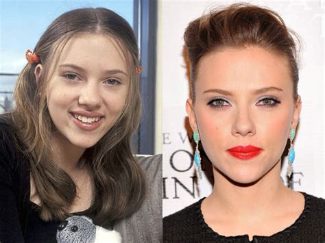Scarlett Johansson Before And After Hair Implants Celebrity Plastic