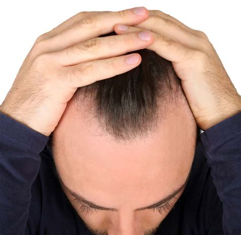 Losing The Battle Against Hair Loss Hair Replacement Treatments