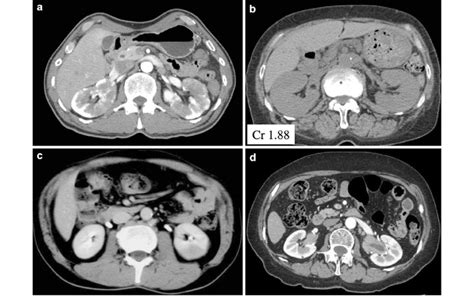 Characteristic Renal Computed Tomography CT Imaging A Multiple