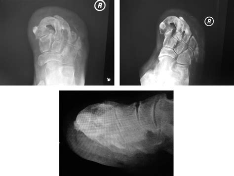An Unusual Presentation Of Bony Overgrowth And Ankylosis After