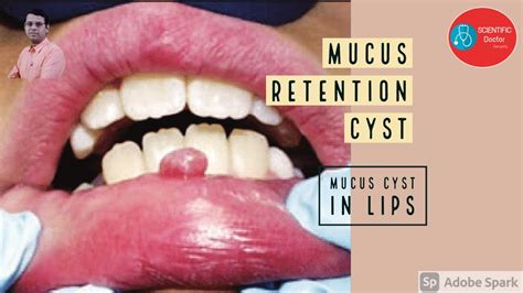 Mucus Cyst In Lips Mucus Retention Cyst Youtube