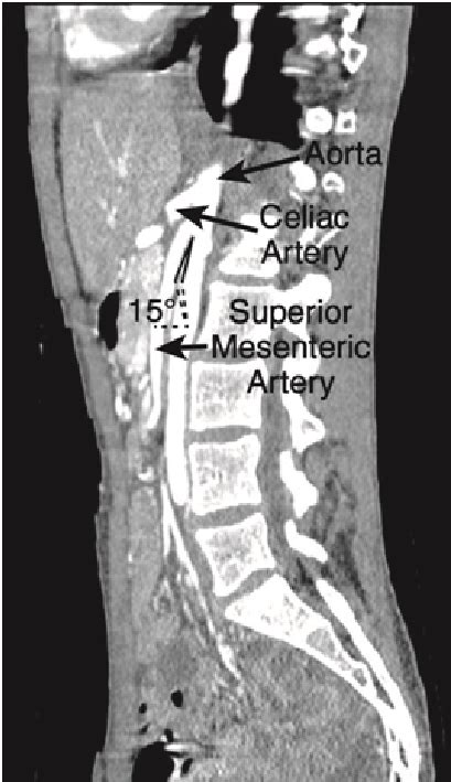 A Sagittal Image Of A Computed Tomography Ct Of Abdomen And Pelvis