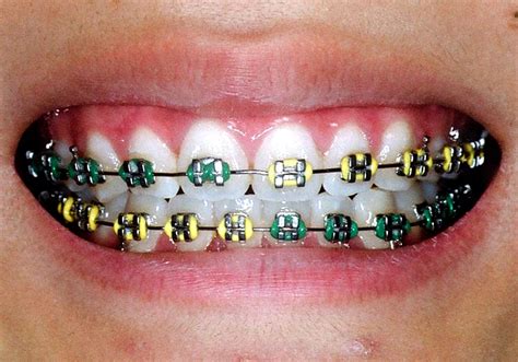 Check spelling or type a new query. Children's Dentist in Gurgaon (Pedodontist) : Parts of Braces