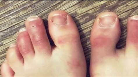 Covid Toes And Skin Rashes Unusual Coronavirus Symptoms Nbc4 Washington