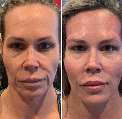Silhouette Instalift West Palm Beach Non Surgical Facelift Palm Beach
