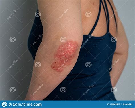 Psoriasis On Elbow Isolated Closeup Of Rash And Scaling On The