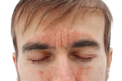 Psoriasis Around The Eyes What To Do And How To Treat