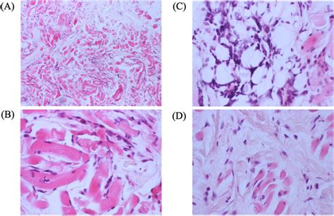 A B Histopathology Findings Of Left Medial Canthal Lesion At Low A