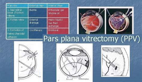 Pars Plana Vitrectomy Ppv And Patients Education I Obn