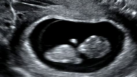 10 week transvaginal ultrasound my xxx hot girl