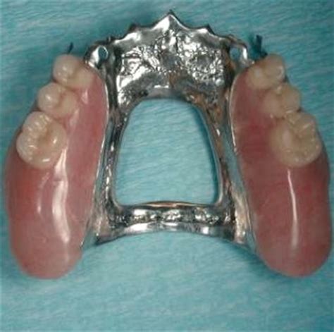 removable partial dentures esthetics rotational path