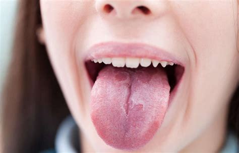 Geographic Tongue 10 Causes Of Geographic Tongue