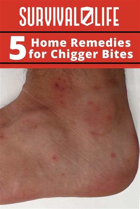Check Out 5 Home Remedies For Chigger Bites At