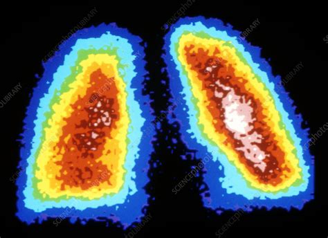 Gamma Ray Scan Of Healthy Human Lungs Stock Image P5900179