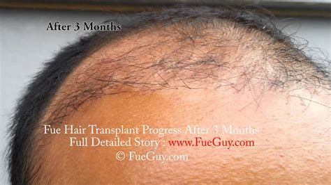 Fue After 3 Months New Hair Growing Fue 3 Months Hair Transplant