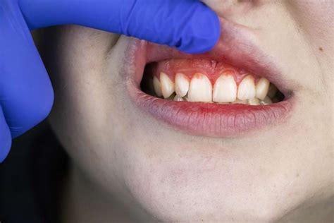 Bleeding Swollen Gums Linked To Severe Covid 19 Cases