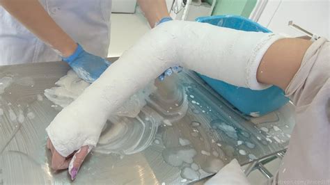 Betty In Double Long Arm Plaster Casts Youtube