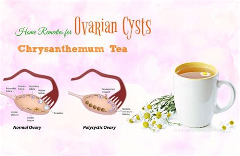 Top 15 Simple Home Remedies For Ovarian Cysts Relief