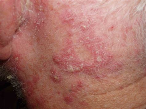 Seborrheic Dermatitis Charlie Goldberg Md Ucsd Grepmed