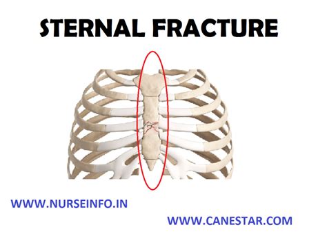 Sternal Fracture Nurse Info