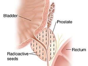 Premature Ejaculation And Lasting Longer Erectile Rejuvenation Scar Tissue From Prostate