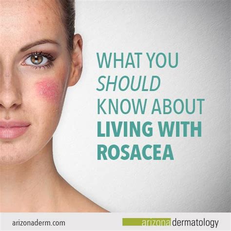 All You Need To Know About Rosacea And Its Treatment Ph