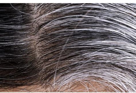 Premature Graying Of Hair Symptoms Causes And Treatment Santripty